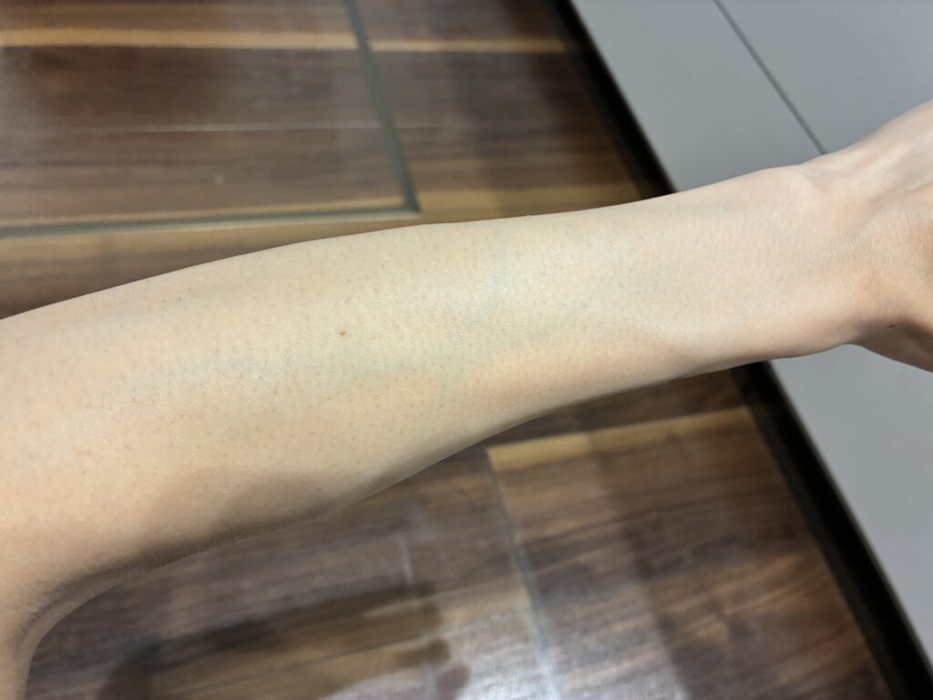 マイトレックス ミライ4ヶ月経過した左腕