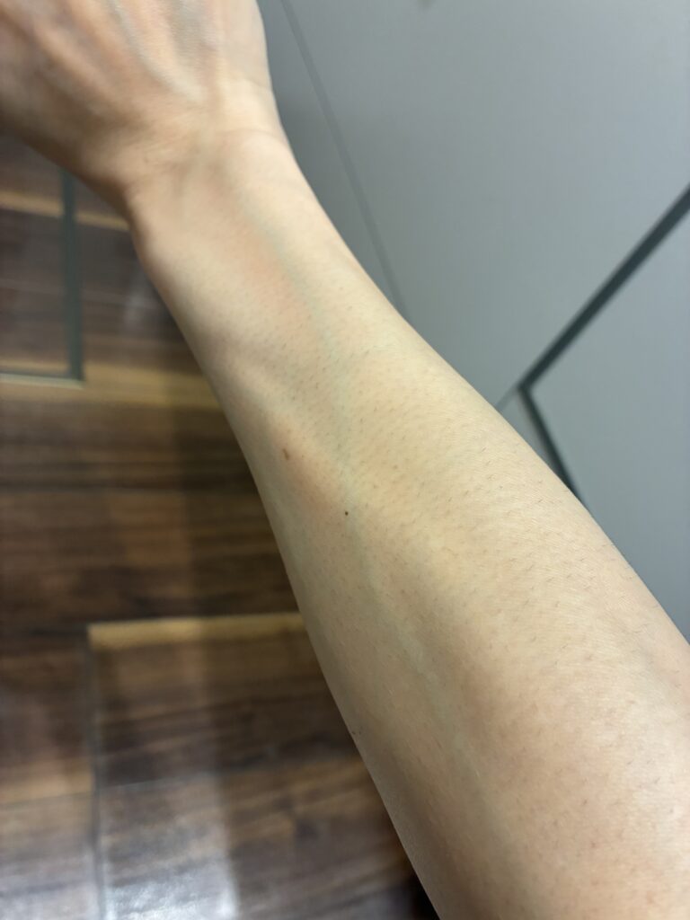 マイトレックス ミライ4ヶ月経過した右腕